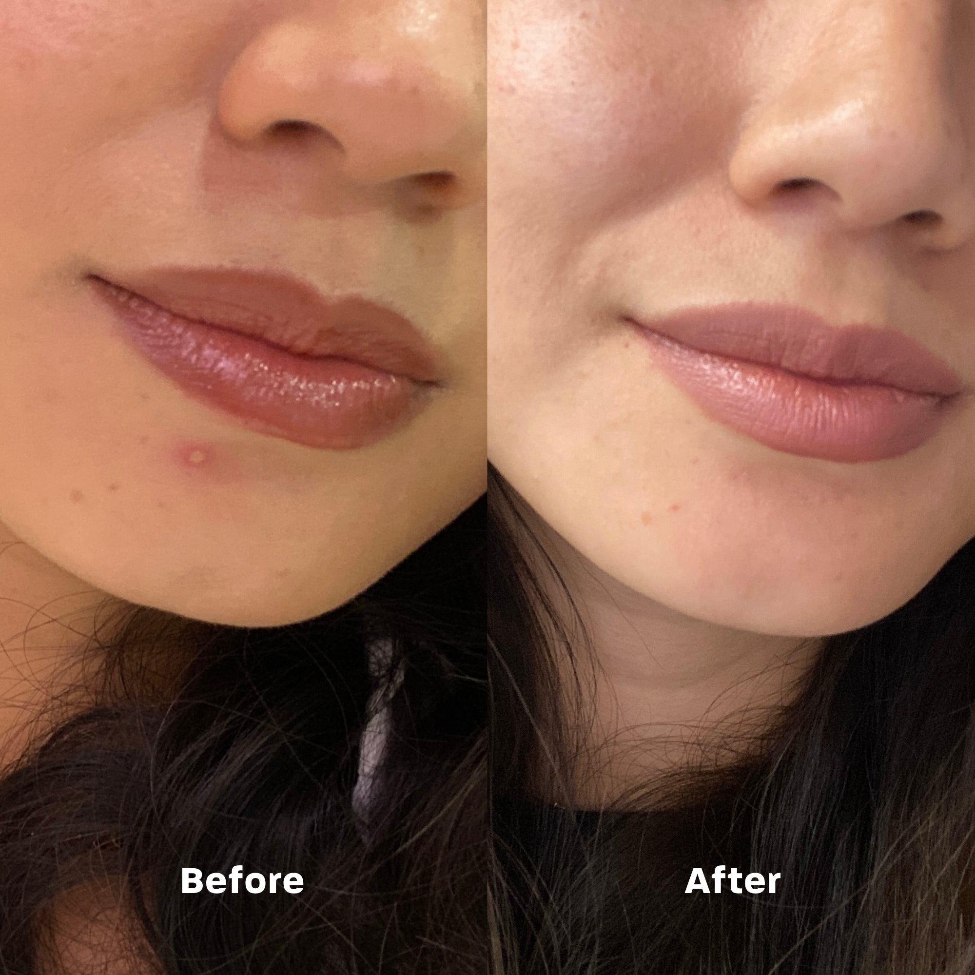 An effective salicylic acid-infused hydrocolloid patch that targets blemishes by absorbing impurities, calming irritation, and speeding healing for clearer, healthier-looking skin day or night.