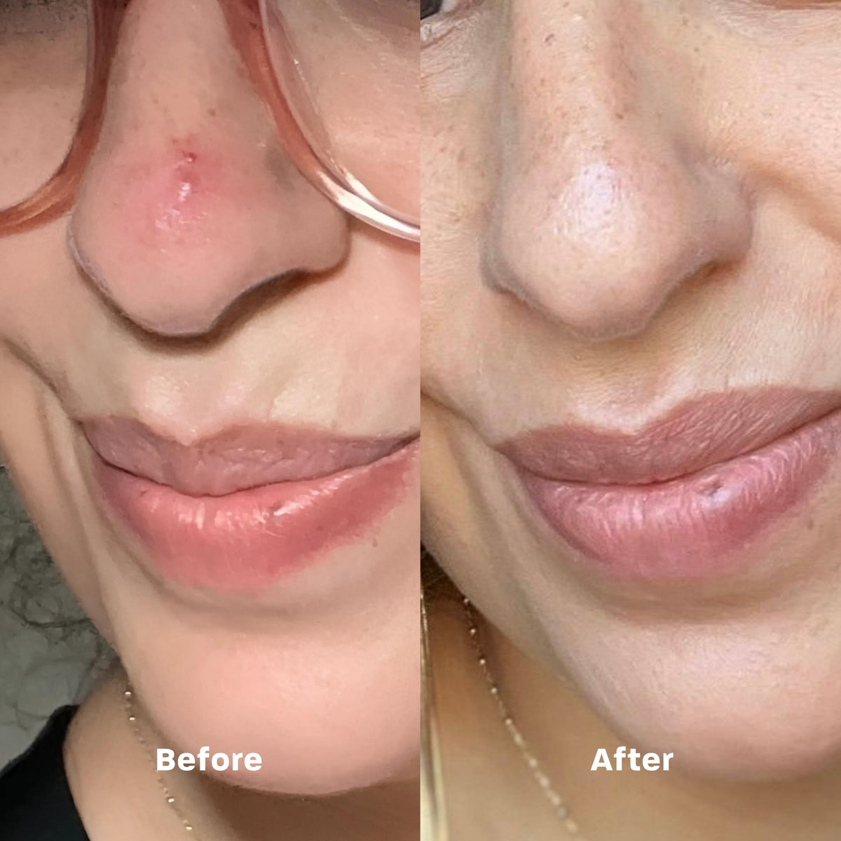An LED patch that uses red, blue, and purple light therapy to target breakouts, soothe irritation, and accelerate skin healing—anytime, anywhere.