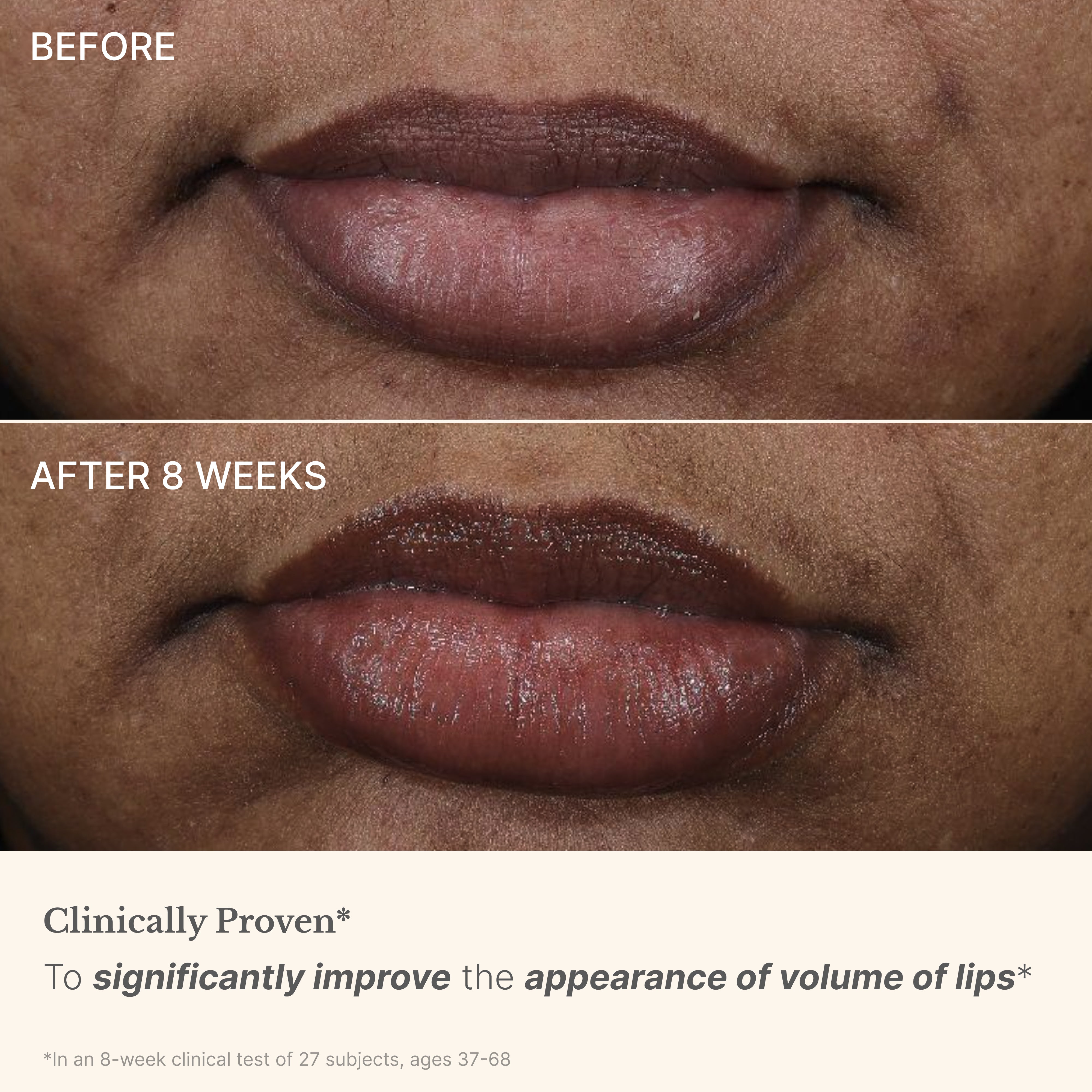 High Performance Lip Filler